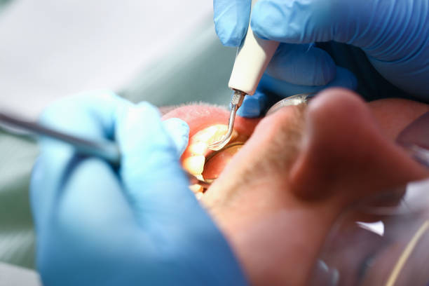 Best Emergency Wisdom Tooth Extraction in Claypool Hill, VA